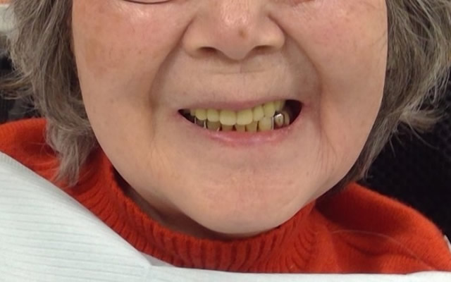 口腔ケア後（患者さんの笑顔の口元）
