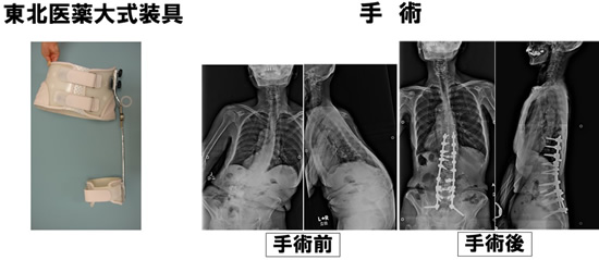 新しいタイプの装具の作製や手術