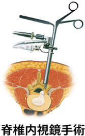 脊椎手術